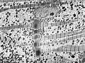 M,42y. | mild endocardial fibrosis - left ventricle (focal contractions of myofibrils)